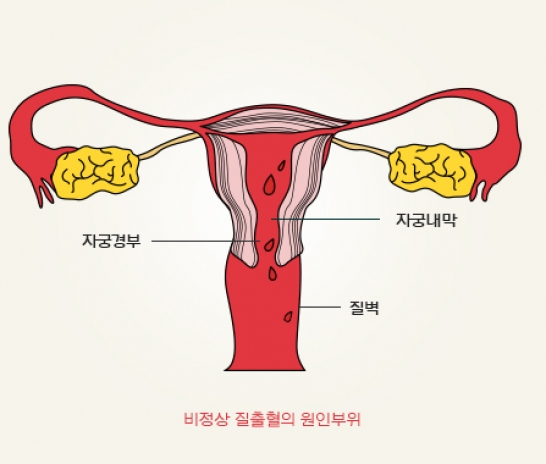 [부정출혈]하혈이 지속된다면 치료가 필요합니다.